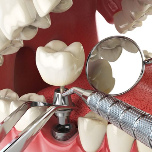 How-to-Maintain-Your-New-Implants